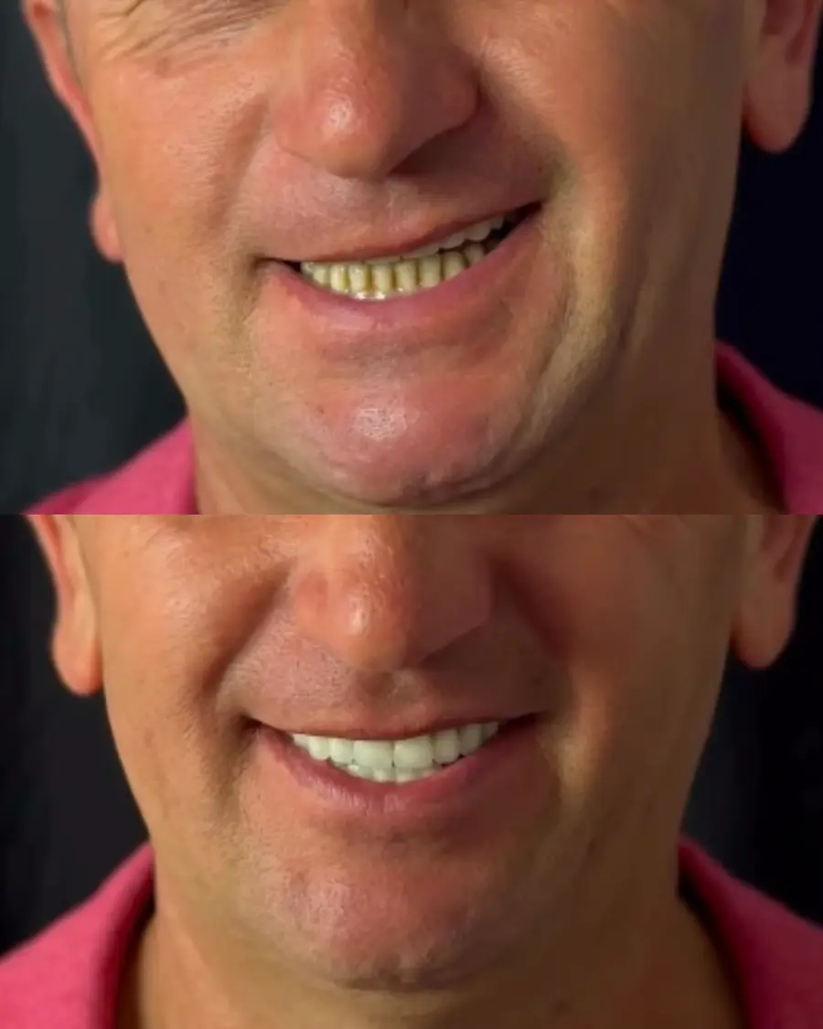 Antes e depois de um paciente da Clínica Dentária União reabilitado com dentes fixos
