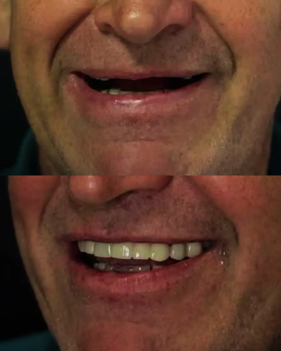 Antes e depois de um paciente da Clínica Dentária União que voltou a mastigar com firmeza