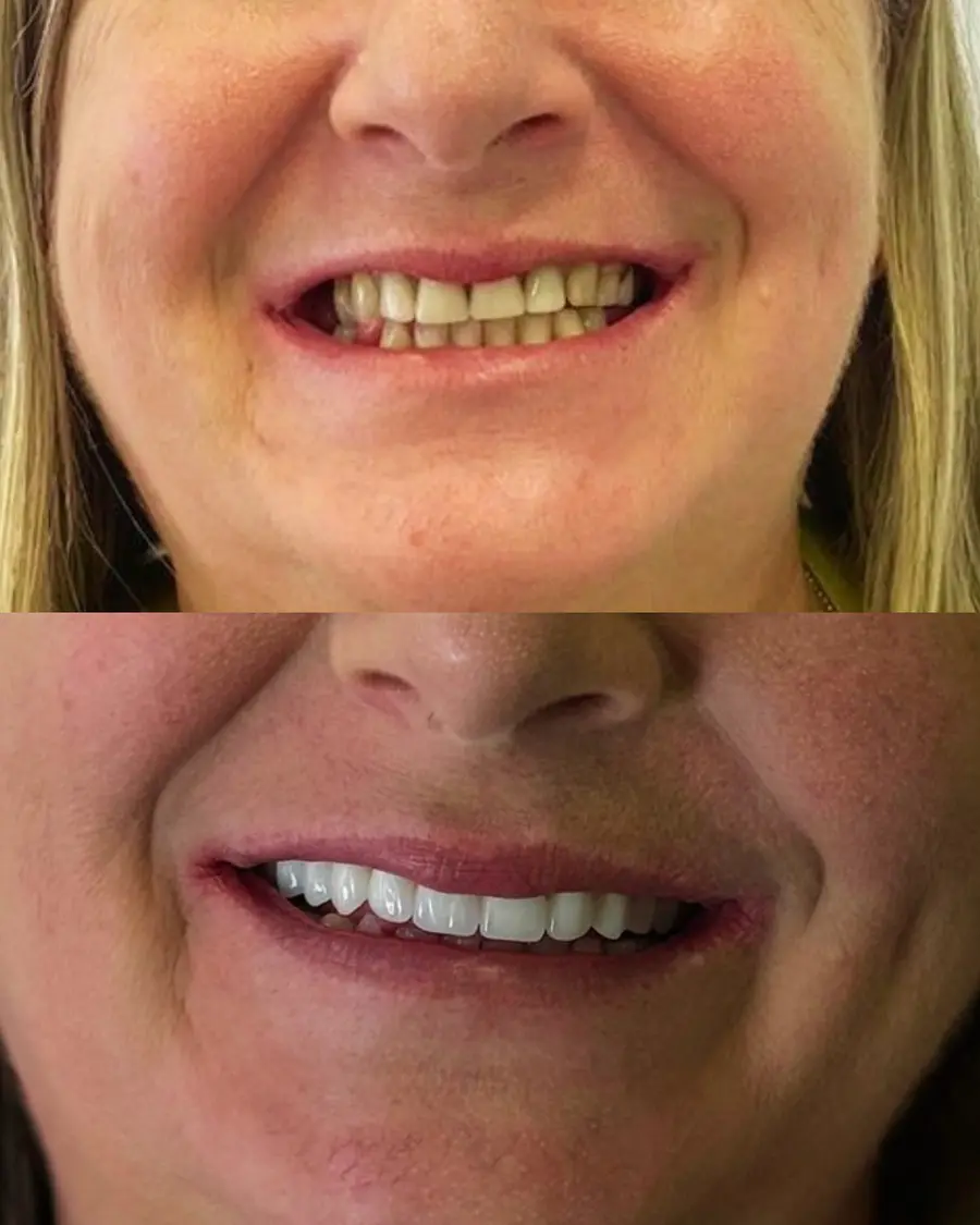Antes e depois de uma paciente da Clínica Dentária União com dentes fixos