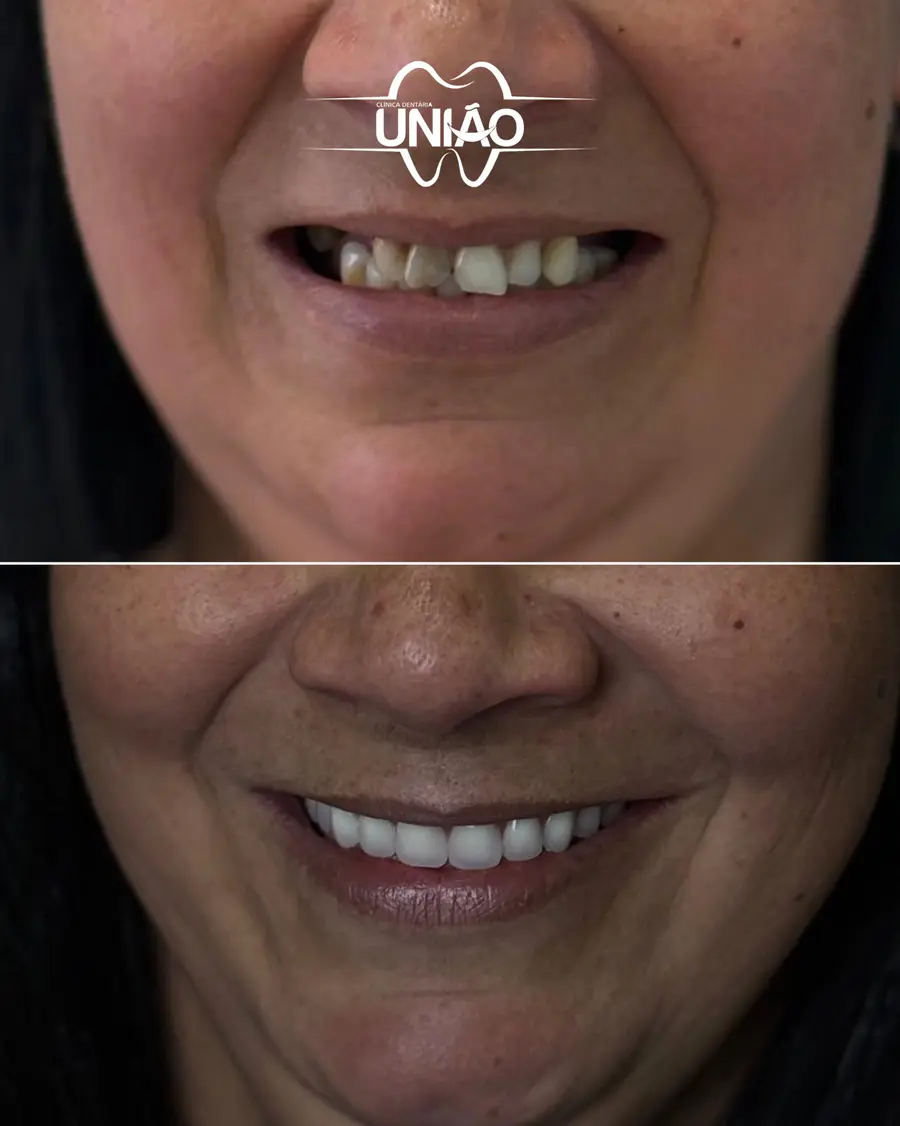 Antes e depois de uma paciente da Clínica Dentária União que recuperou o sorriso