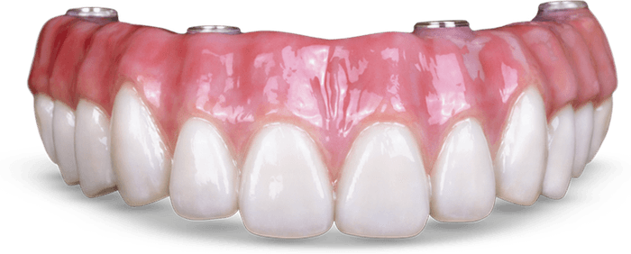 Prótese de dentes fixos parafusada sobre implantes