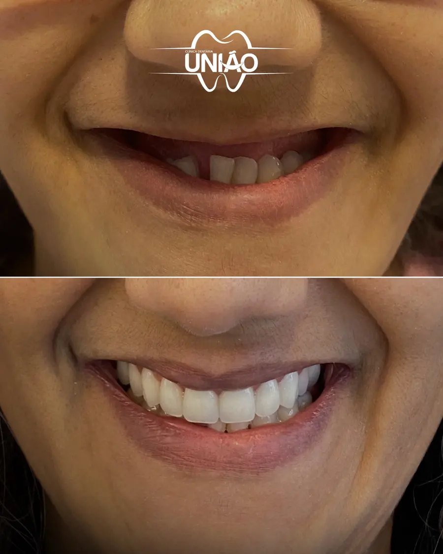 Paciente da Clínica Dentária União antes e depois de recuperar os dentes fixos